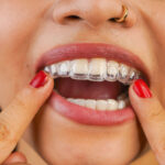 Invisalign