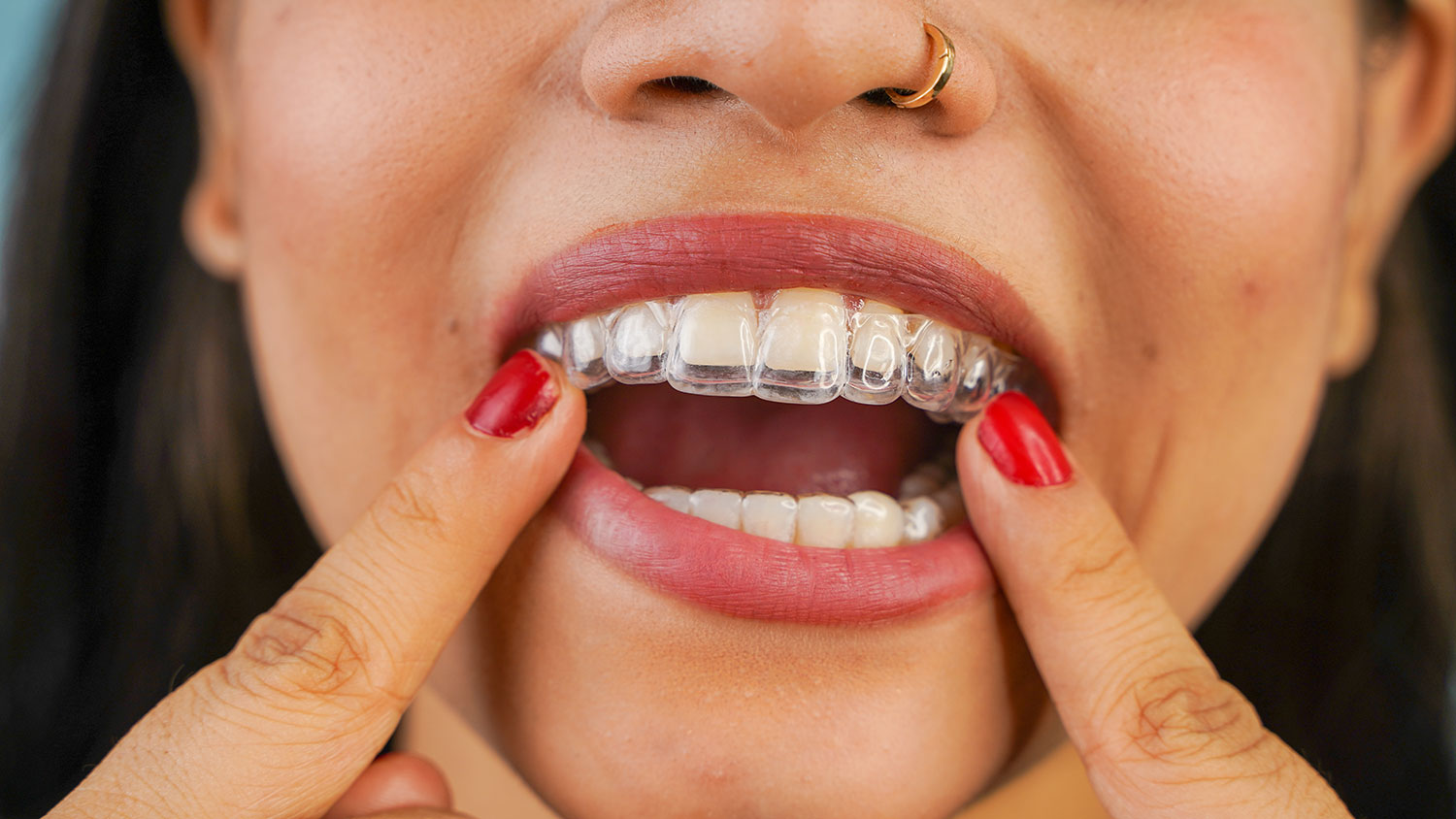 Invisalign